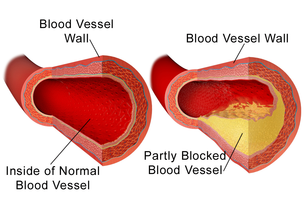 What Is Cholesterol And How Does It Affect Your Heart?